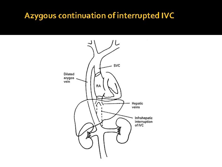 Azygous continuation of interrupted IVC 