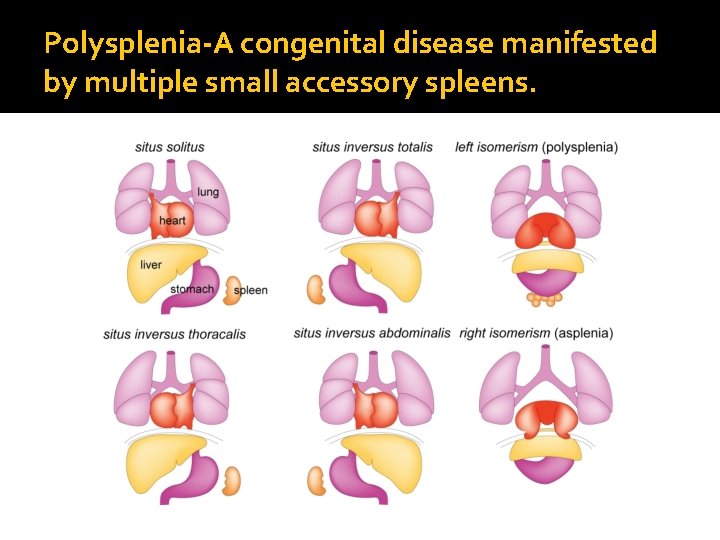 Polysplenia-A congenital disease manifested by multiple small accessory spleens. 