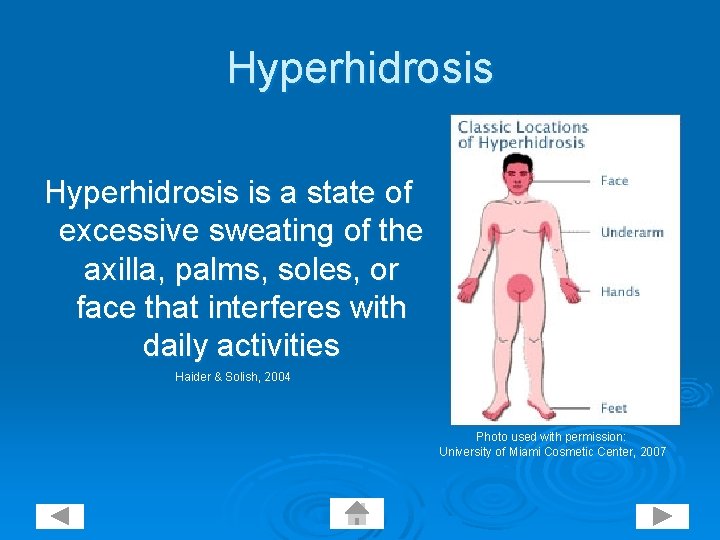 Hyperhidrosis is a state of excessive sweating of the axilla, palms, soles, or face