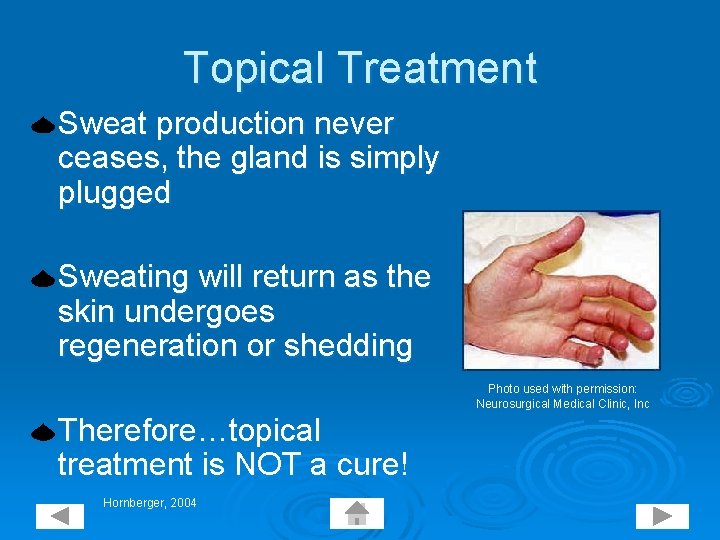 Topical Treatment Sweat production never ceases, the gland is simply plugged Sweating will return