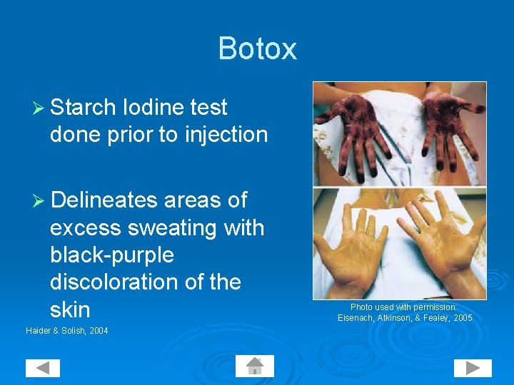 Botox Ø Starch Iodine test done prior to injection Ø Delineates areas of excess