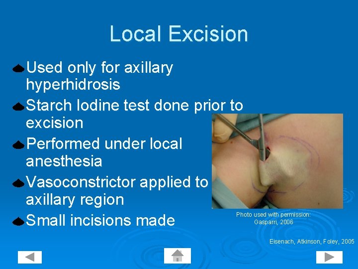 Local Excision Used only for axillary hyperhidrosis Starch Iodine test done prior to excision