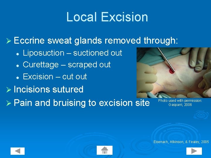 Local Excision Ø Eccrine sweat glands removed through: l l l Liposuction – suctioned