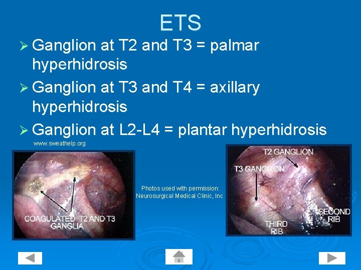 ETS Ø Ganglion at T 2 and T 3 = palmar hyperhidrosis Ø Ganglion