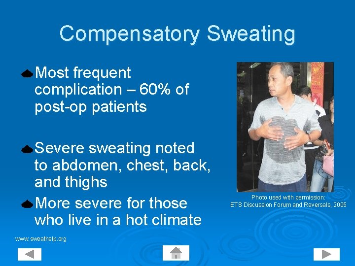 Compensatory Sweating Most frequent complication – 60% of post-op patients Severe sweating noted to