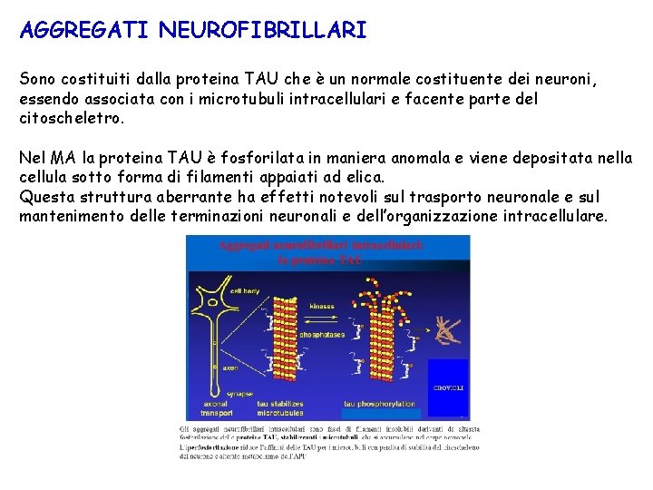 AGGREGATI NEUROFIBRILLARI Sono costituiti dalla proteina TAU che è un normale costituente dei neuroni,