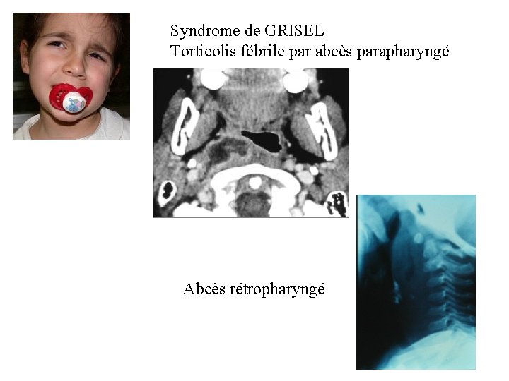 Syndrome de GRISEL Torticolis fébrile par abcès parapharyngé Abcès rétropharyngé 