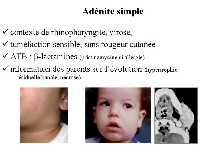 Adénite simple ü contexte de rhinopharyngite, virose, ü tuméfaction sensible, sans rougeur cutanée ü