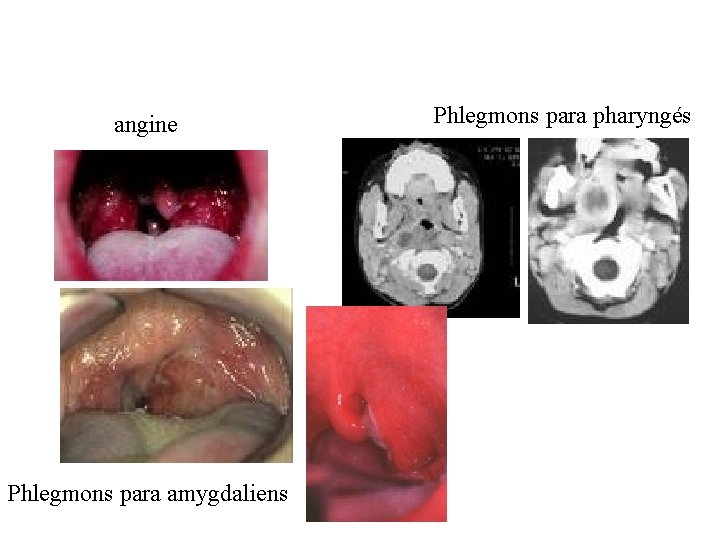 angine Phlegmons para amygdaliens Phlegmons para pharyngés 