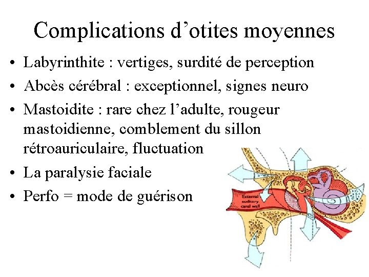 Complications d’otites moyennes • Labyrinthite : vertiges, surdité de perception • Abcès cérébral :