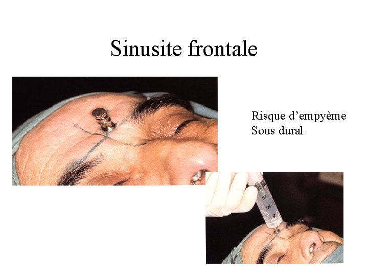 Sinusite frontale Risque d’empyème Sous dural 