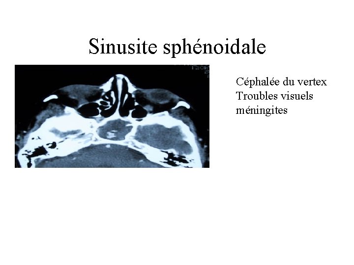 Sinusite sphénoidale Céphalée du vertex Troubles visuels méningites 