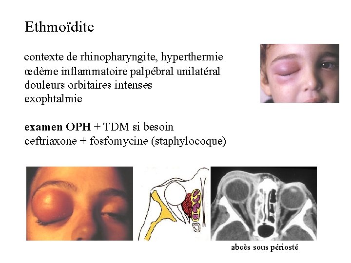  Ethmoïdite contexte de rhinopharyngite, hyperthermie œdème inflammatoire palpébral unilatéral douleurs orbitaires intenses exophtalmie
