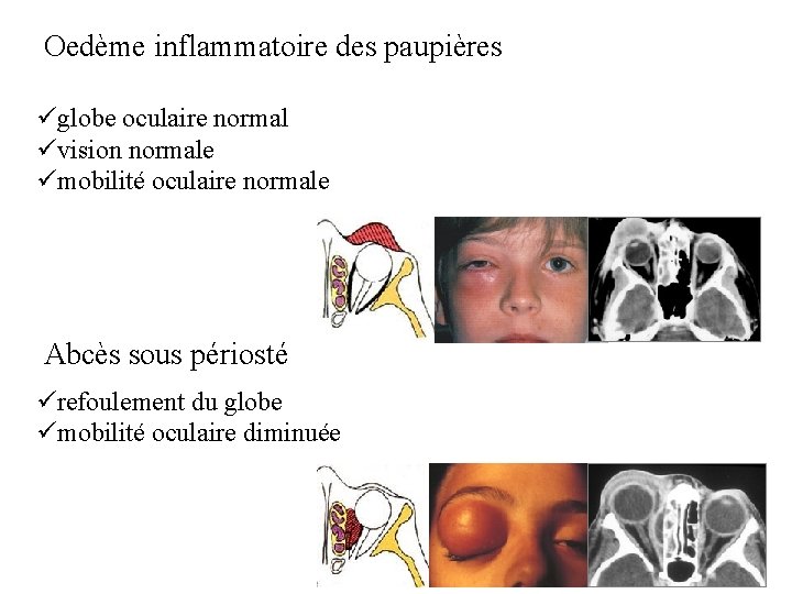  Oedème inflammatoire des paupières üglobe oculaire normal üvision normale ümobilité oculaire normale Abcès