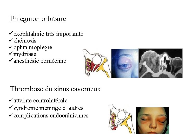  Phlegmon orbitaire üexophtalmie très importante üchémosis üophtalmoplégie ümydriase üanesthésie cornéenne Thrombose du sinus