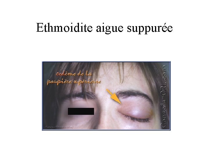 Ethmoidite aigue suppurée 
