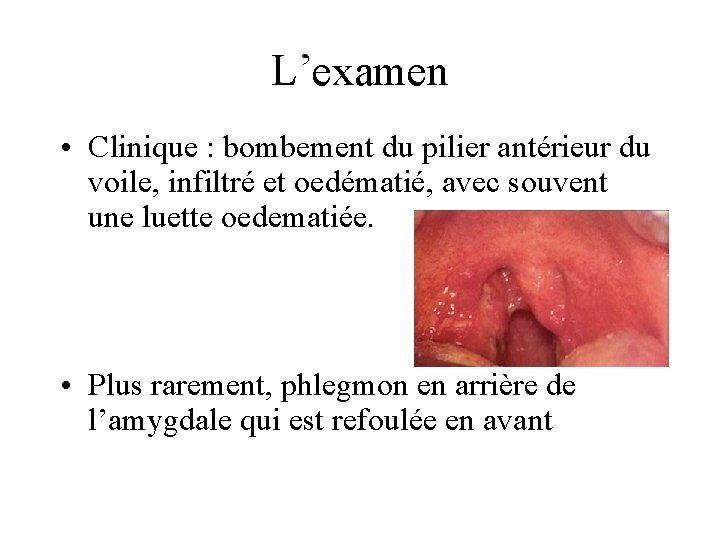 L’examen • Clinique : bombement du pilier antérieur du voile, infiltré et oedématié, avec