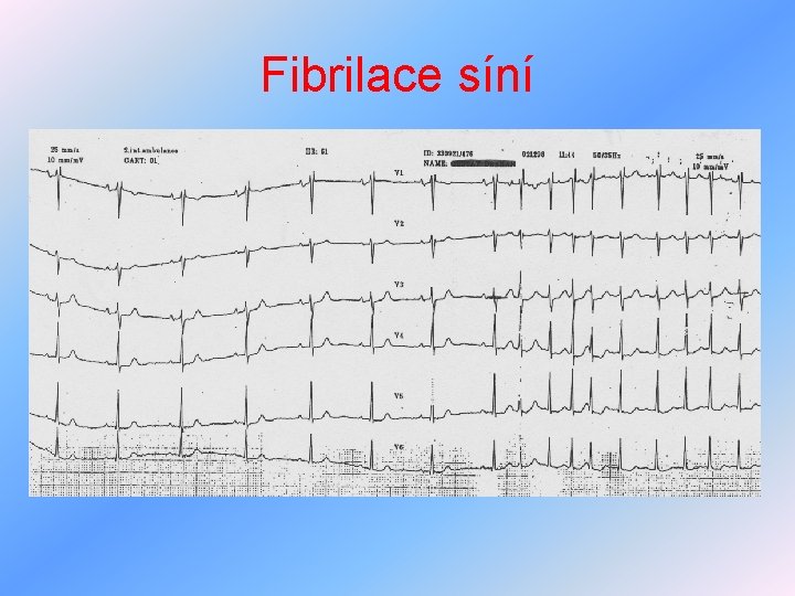 Fibrilace síní 