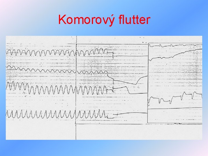 Komorový flutter 