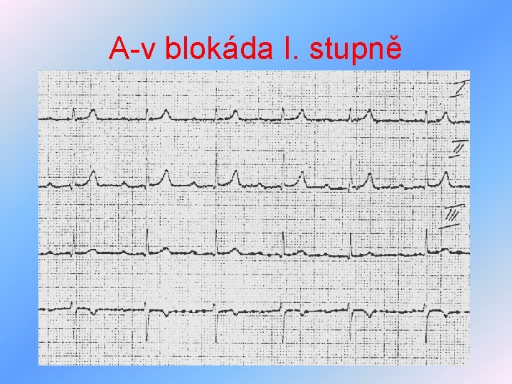 A-v blokáda I. stupně 