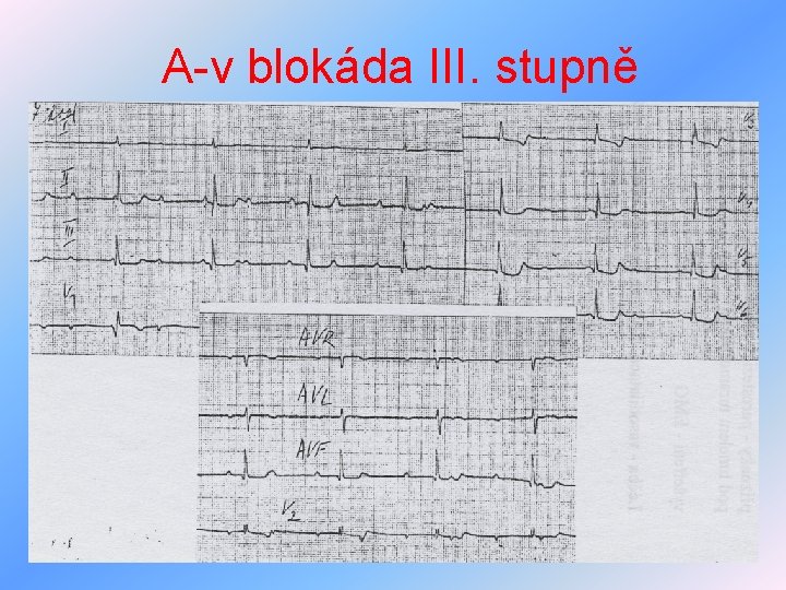 A-v blokáda III. stupně 