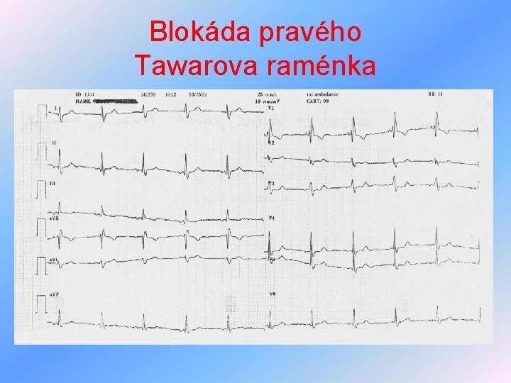 Blokáda pravého Tawarova raménka 