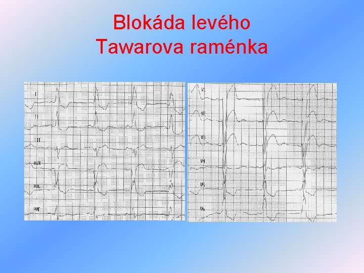 Blokáda levého Tawarova raménka 