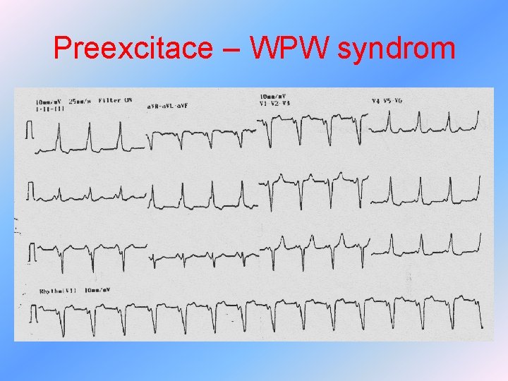 Preexcitace – WPW syndrom 