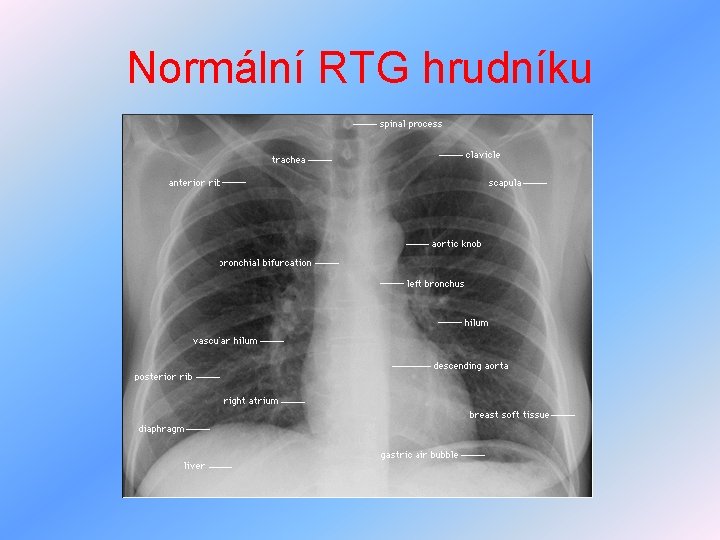 Normální RTG hrudníku 