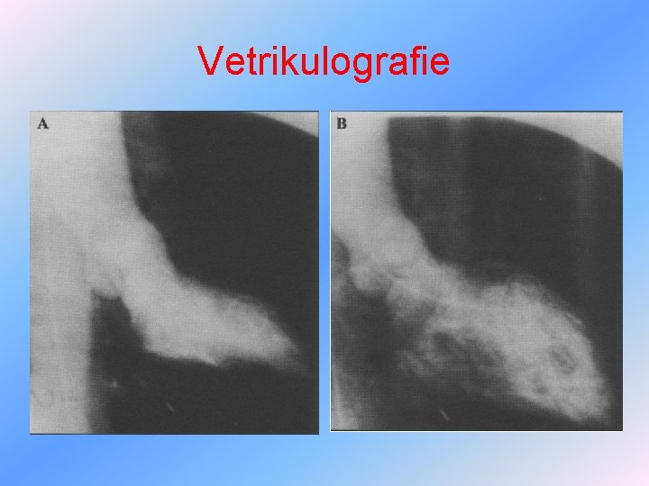 Vetrikulografie 