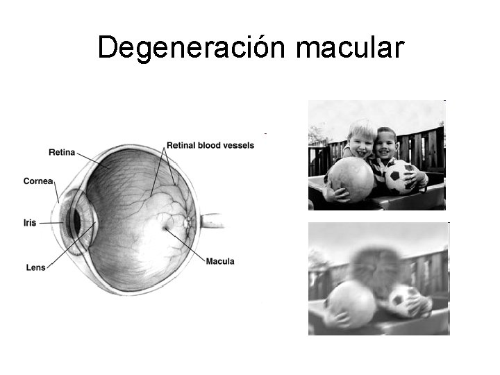 Degeneración macular 