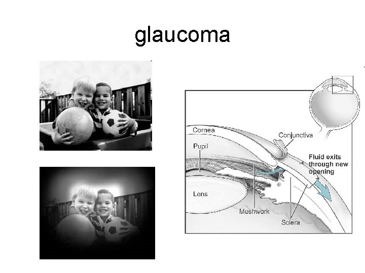 glaucoma 