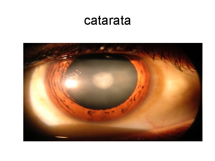 catarata 