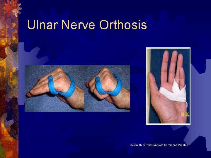 Ulnar Nerve Orthosis Used with permission from Sammons Preston Ulnar Nerve Orthosis Used with permission from Sammons Preston