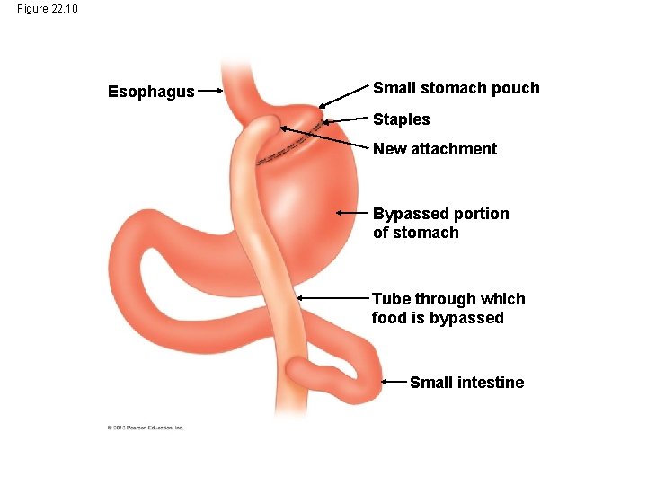 Figure 22. 10 Esophagus Small stomach pouch Staples New attachment Bypassed portion of stomach Figure 22. 10 Esophagus Small stomach pouch Staples New attachment Bypassed portion of stomach