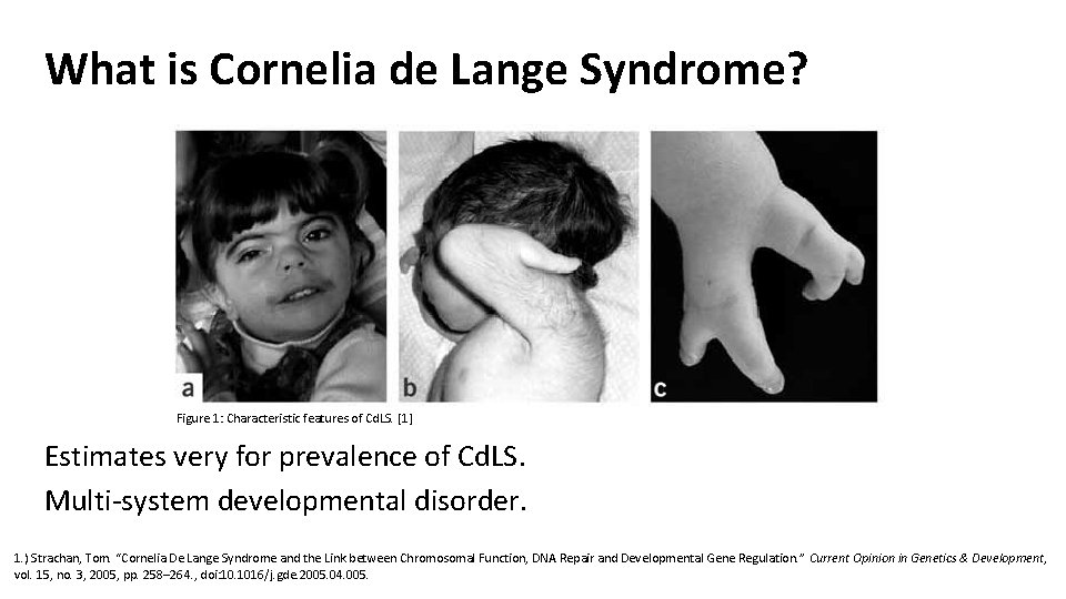What is Cornelia de Lange Syndrome? Figure 1: Characteristic features of Cd. LS. [1]
