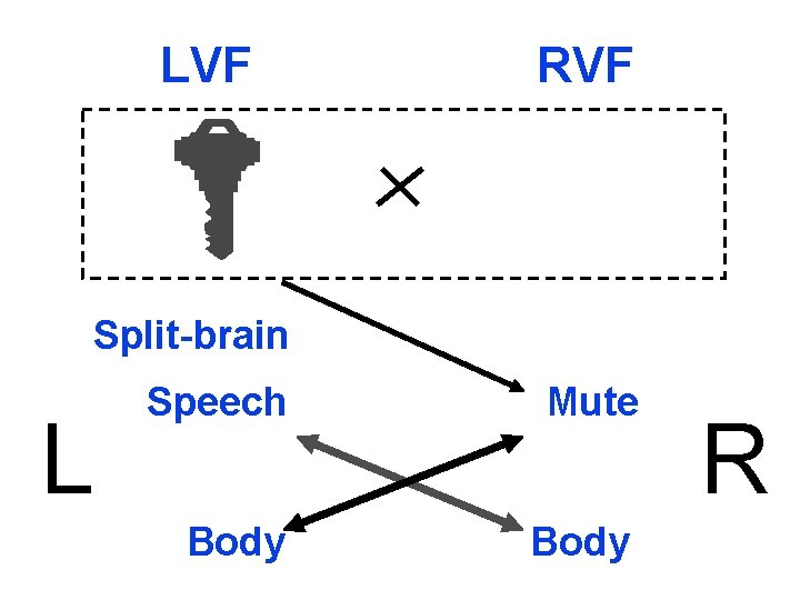 LVF RVF Split-brain L Speech Mute Body R 