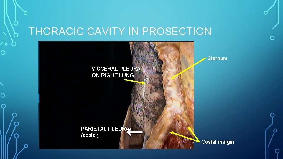 THORACIC CAVITY IN PROSECTION Sternum VISCERAL PLEURA ON RIGHT LUNG PARIETAL PLEURA (costal) Costal
