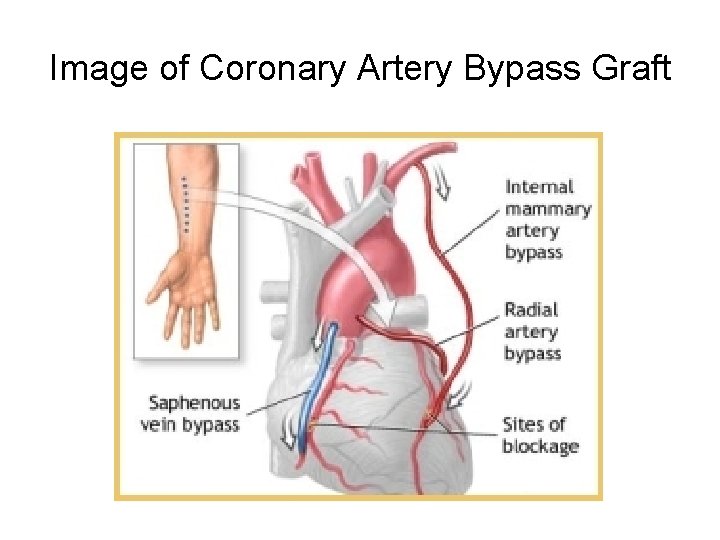 Image of Coronary Artery Bypass Graft 