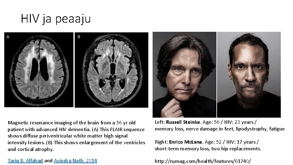 HIV ja peaaju Magnetic resonance imaging of the brain from a 56 yr old