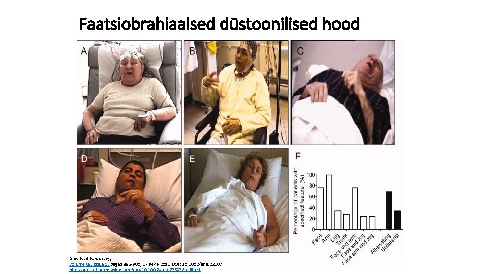 Faatsiobrahiaalsed düstoonilised hood Annals of Neurology Volume 69, Issue 5, pages 892 -900, 17