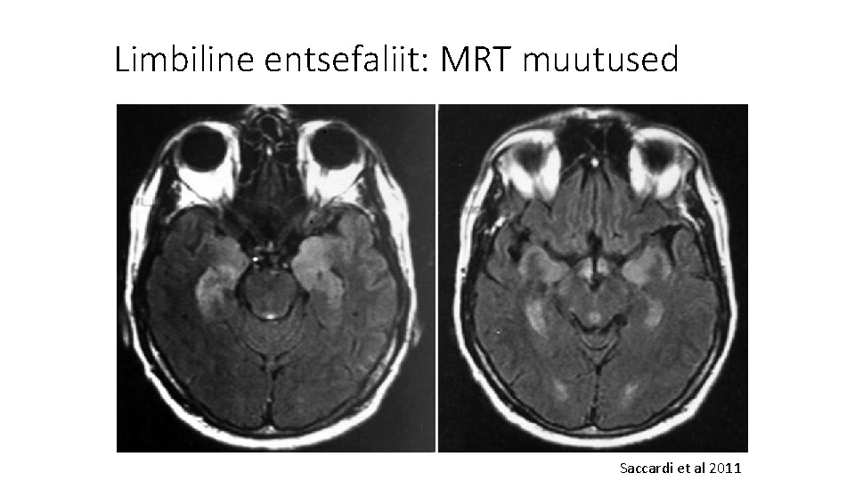 Limbiline entsefaliit: MRT muutused Saccardi et al 2011 