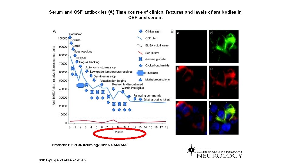 Serum and CSF antibodies (A) Time course of clinical features and levels of antibodies