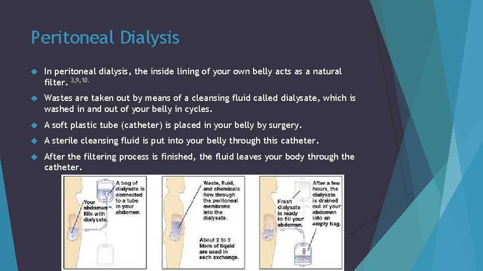 Peritoneal Dialysis In peritoneal dialysis, the inside lining of your own belly acts as