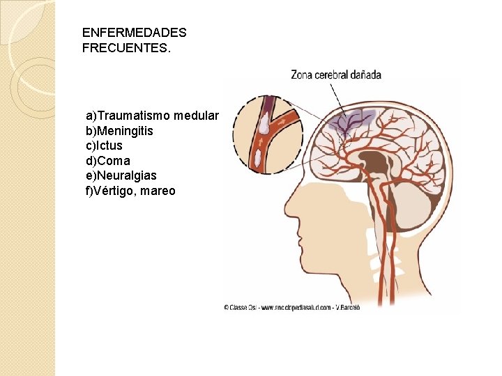 ENFERMEDADES FRECUENTES. a)Traumatismo medular b)Meningitis c)Ictus d)Coma e)Neuralgias f)Vértigo, mareo 