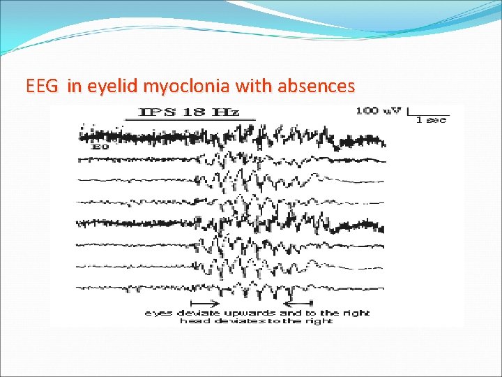 EEG in eyelid myoclonia with absences EEG in eyelid myoclonia with absences