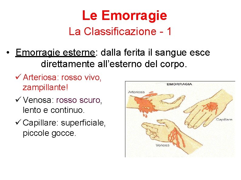 Le Emorragie La Classificazione - 1 • Emorragie esterne: dalla ferita il sangue esce