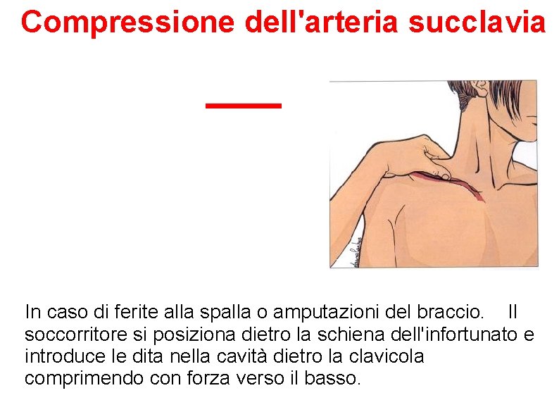 Compressione dell'arteria succlavia In caso di ferite alla spalla o amputazioni del braccio. Il