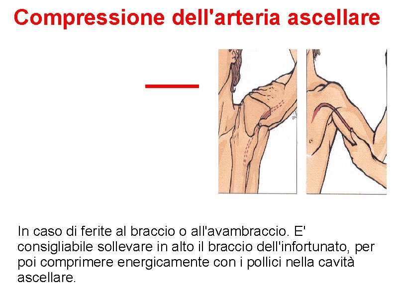 Compressione dell'arteria ascellare In caso di ferite al braccio o all'avambraccio. E' consigliabile sollevare