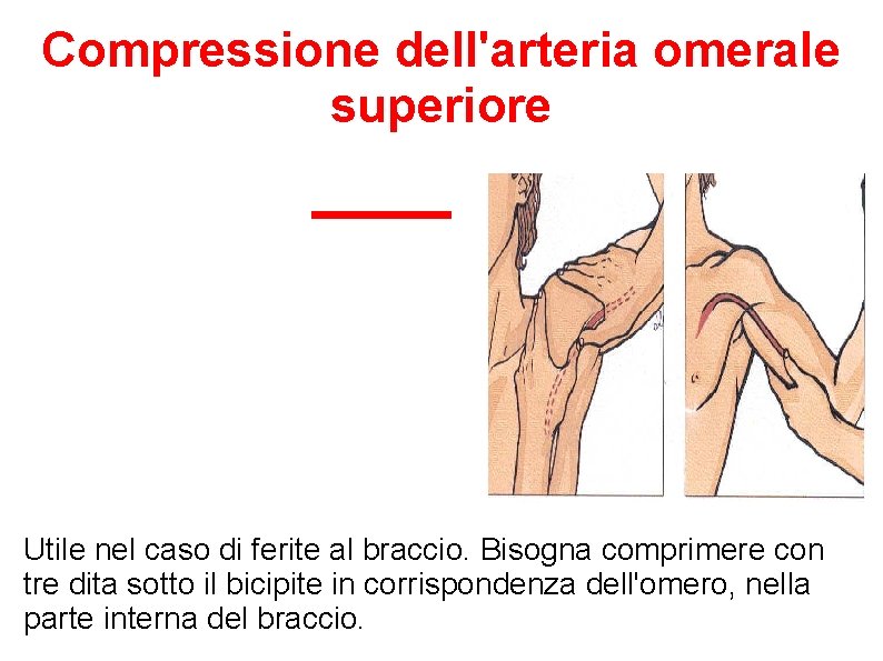 Compressione dell'arteria omerale superiore Utile nel caso di ferite al braccio. Bisogna comprimere con